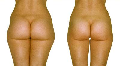 traitement pour cellulite